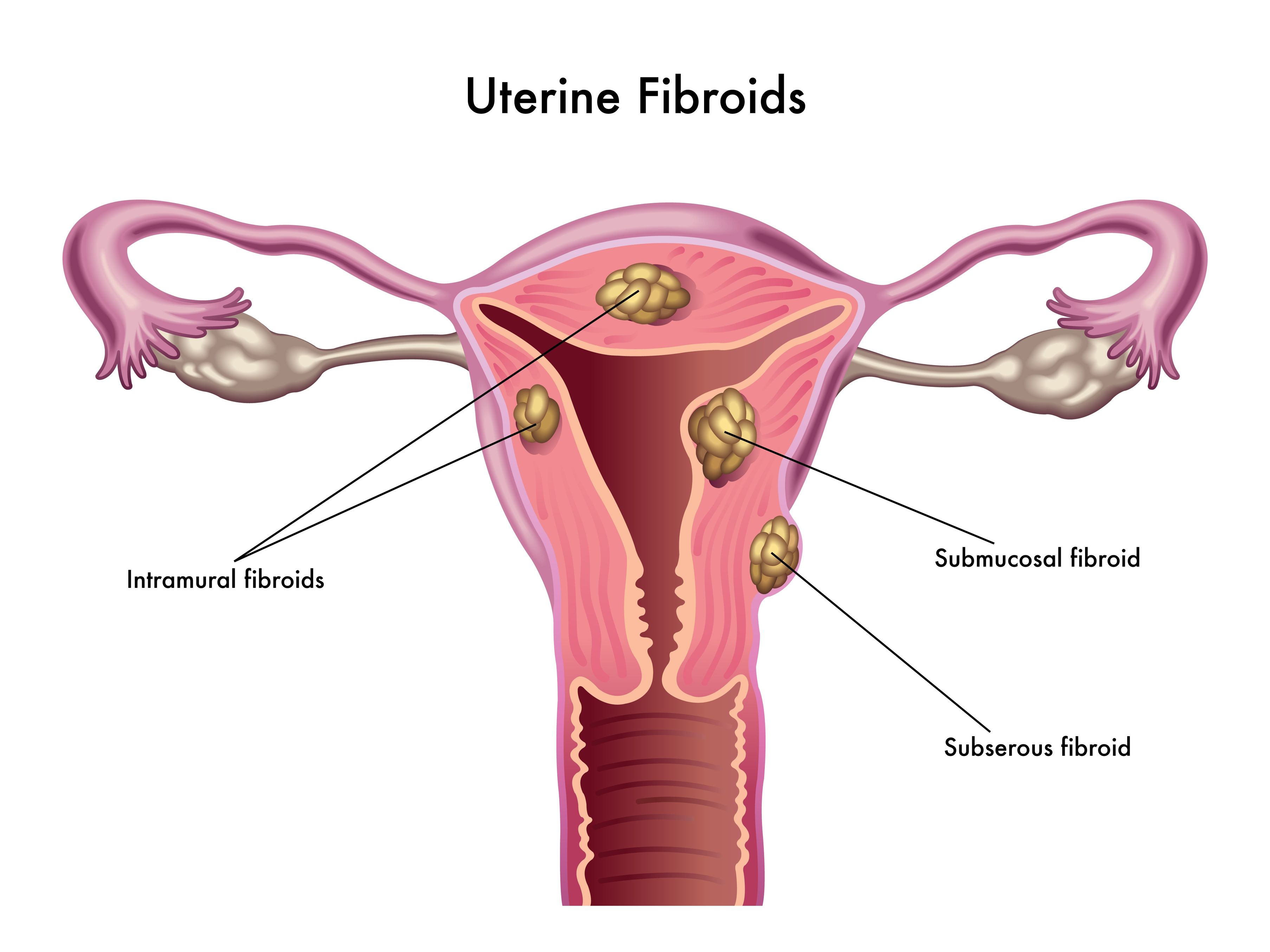 Ce ar trebui sa stiti despre fibroamele uterine la menopauza