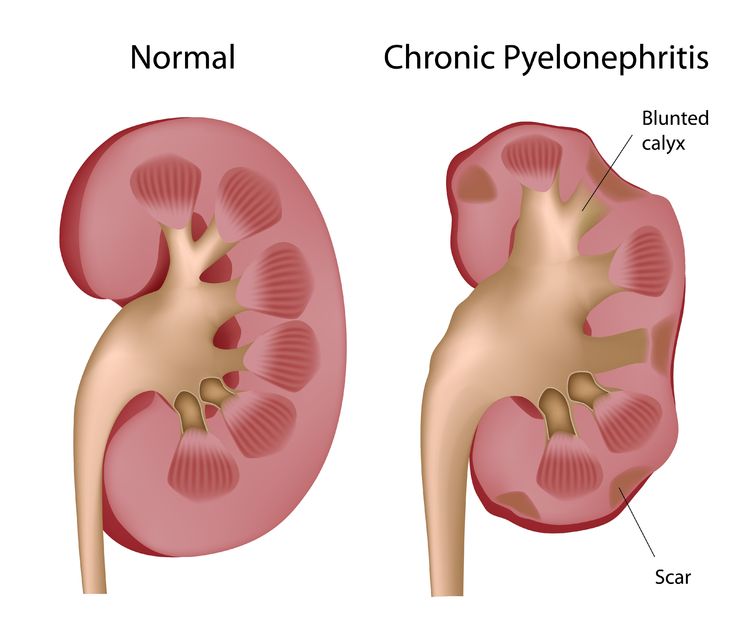 Kidney Infection (Pyelonephritis)